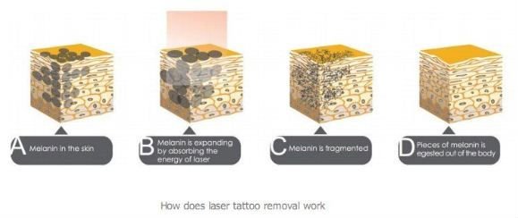 Sistema profesional del retiro del tatuaje del laser del yag del nd del interruptor de la clínica q con la promoción grande