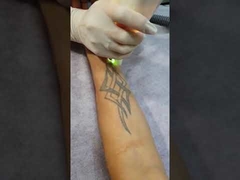 Máquina de c4q conmutado del retiro del tatuaje del laser de Yag de la maleta portátil K11