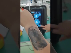Dispositivo de eliminación de tatuajes con láser P9 Nd Yag de picosegundos