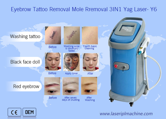 1064nm 532nm Nd Yag Máquina de eliminación de tatuajes con láser Dermatología