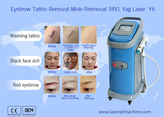 1064nm/532nm dermatología de la máquina del retiro del tatuaje del laser del Nd Yag